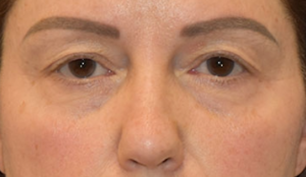 Blepharoplasty - Dr. John Layliev