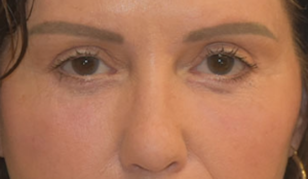 Blepharoplasty - Dr. John Layliev