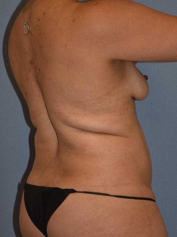 Tummy Tuck Before & After Gallery - Patient 110656 - Image 5