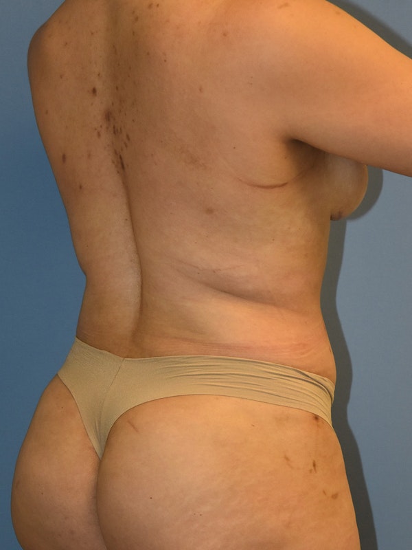 Tummy Tuck Before & After Gallery - Patient 110656 - Image 6