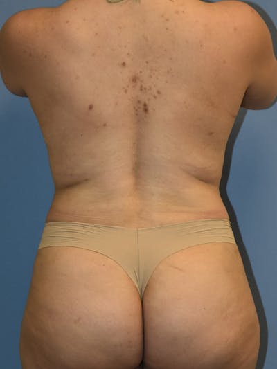 Tummy Tuck Before & After Gallery - Patient 110656 - Image 12