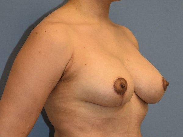 Breast Augmentation with Lift Before & After Gallery - Patient 254454 - Image 2