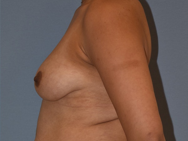 Breast Augmentation with Lift Before & After Gallery - Patient 254454 - Image 7
