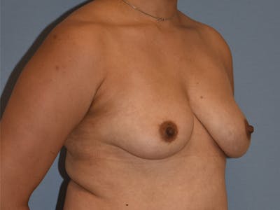 Breast Augmentation with Lift Before & After Gallery - Patient 254454 - Image 1
