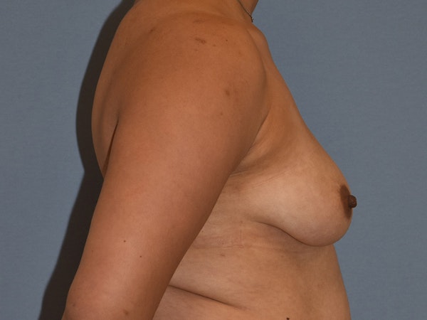Breast Augmentation with Lift Before & After Gallery - Patient 254454 - Image 3