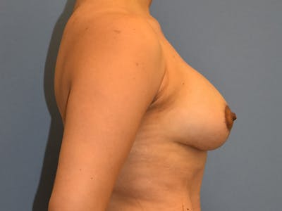 Breast Augmentation with Lift Before & After Gallery - Patient 254454 - Image 4