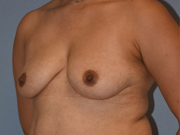 Breast Augmentation with Lift Before & After Gallery - Patient 254454 - Image 5