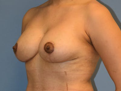 Breast Augmentation with Lift Before & After Gallery - Patient 254454 - Image 6