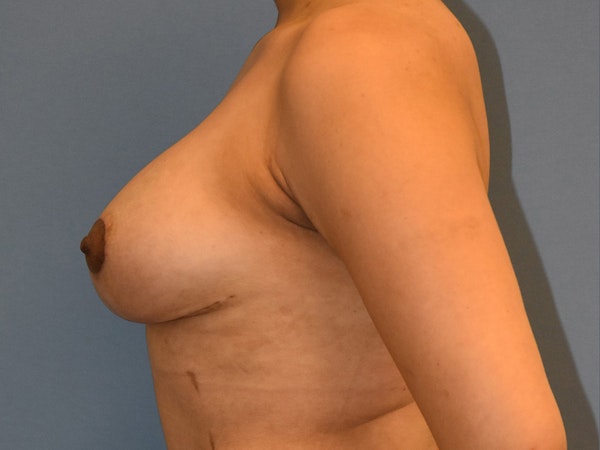 Breast Augmentation with Lift Before & After Gallery - Patient 254454 - Image 8