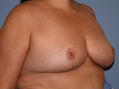 Breast Reduction Before & After Gallery - Patient 147362 - Image 4