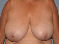 Breast Reduction Before & After Gallery - Patient 147362 - Image 1