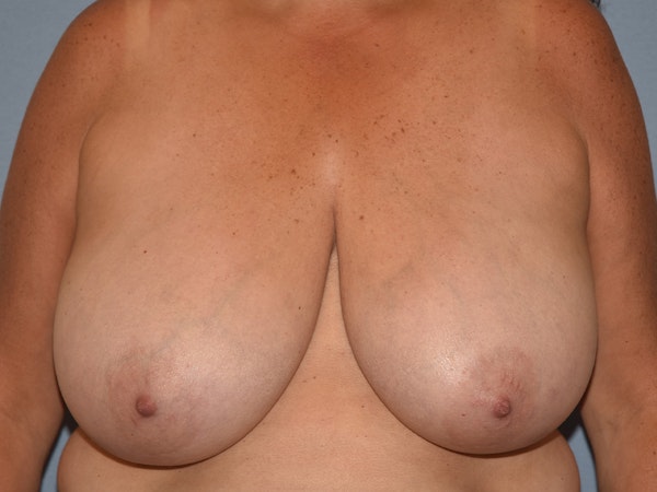 Breast Reduction Before & After Gallery - Patient 147362 - Image 1