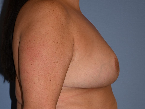 Breast Reduction Before & After Gallery - Patient 147362 - Image 6