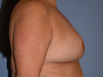 Breast Reduction Before & After Gallery - Patient 147362 - Image 6