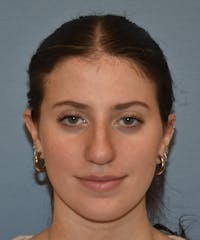 Rhinoplasty Before & After Gallery - Patient 177283 - Image 1