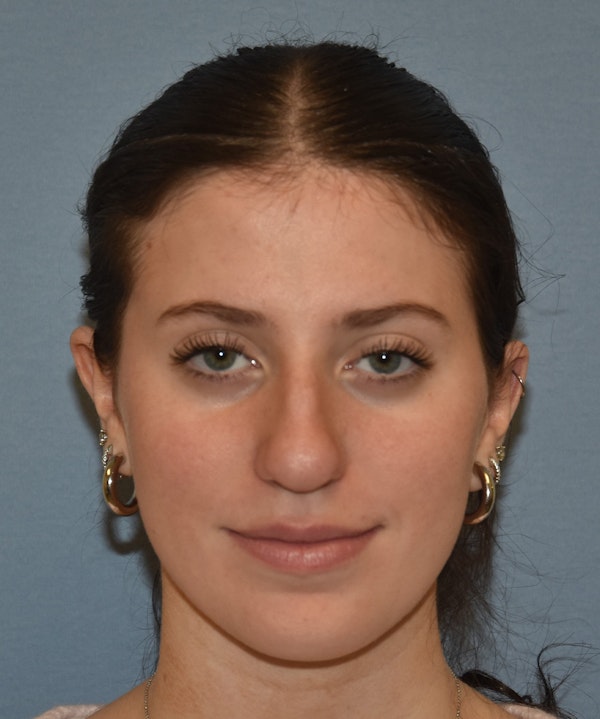 Rhinoplasty Before & After Gallery - Patient 177283 - Image 1