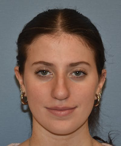 Rhinoplasty Before & After Gallery - Patient 177283 - Image 1