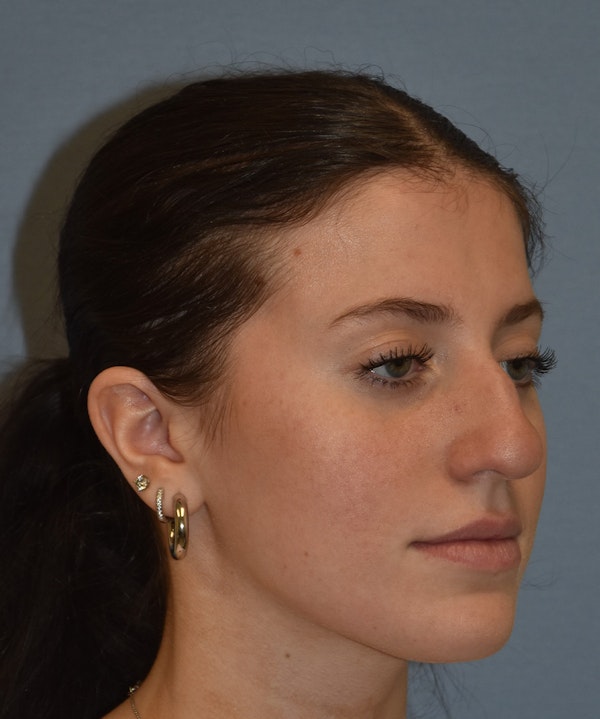 Rhinoplasty Before & After Gallery - Patient 177283 - Image 3
