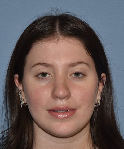 Rhinoplasty Before & After Gallery - Patient 177283 - Image 2