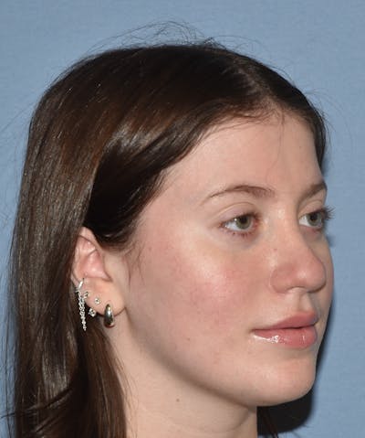 Rhinoplasty Before & After Gallery - Patient 177283 - Image 4