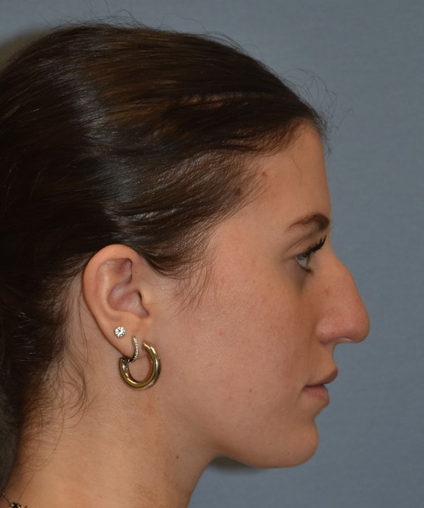 Rhinoplasty Before & After Gallery - Patient 177283 - Image 5