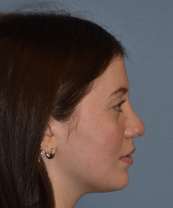 Rhinoplasty Before & After Gallery - Patient 177283 - Image 6