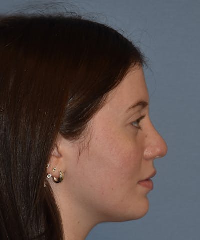 Rhinoplasty Before & After Gallery - Patient 177283 - Image 6