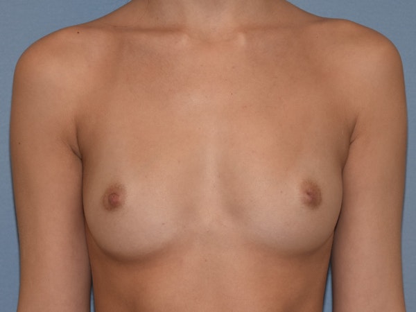 Breast Augmentation Before & After Gallery - Patient 124528 - Image 1