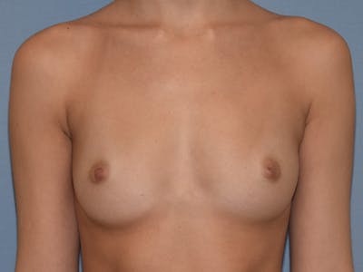 Breast Augmentation Before & After Gallery - Patient 124528 - Image 1