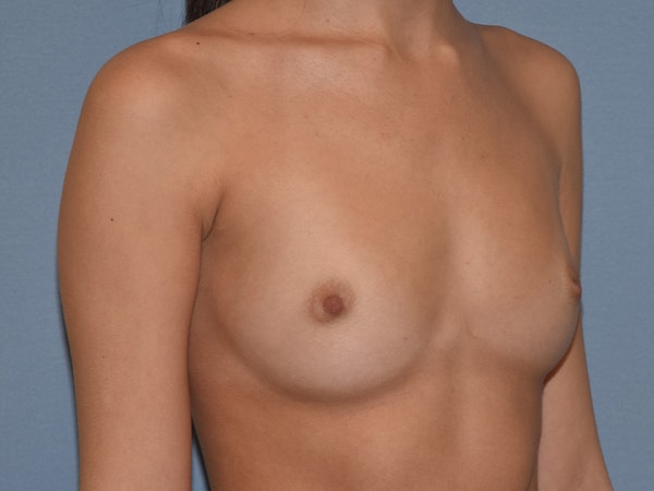 Breast Augmentation Before & After Gallery - Patient 124528 - Image 3