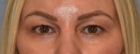 Facial Fat Grafting Before & After Gallery - Patient 295344 - Image 1