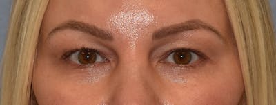 Facial Fat Grafting Before & After Gallery - Patient 295344 - Image 1
