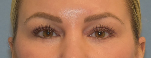 Facial Fat Grafting Before & After Gallery - Patient 295344 - Image 2