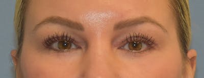 Facial Fat Grafting Before & After Gallery - Patient 295344 - Image 2