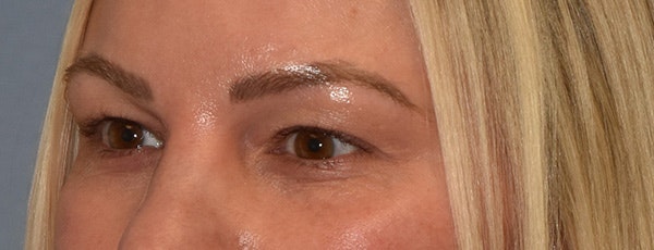 Facial Fat Grafting Before & After Gallery - Patient 295344 - Image 3