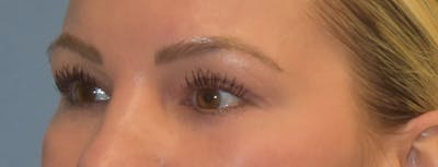 Facial Fat Grafting Before & After Gallery - Patient 295344 - Image 4