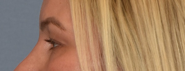 Facial Fat Grafting Before & After Gallery - Patient 295344 - Image 5