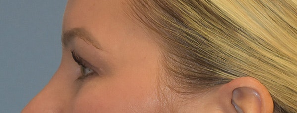 Facial Fat Grafting Before & After Gallery - Patient 295344 - Image 6