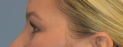 Facial Fat Grafting Before & After Gallery - Patient 295344 - Image 6