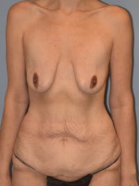 After Weight Loss Surgery Before & After Gallery - Patient 169243 - Image 1