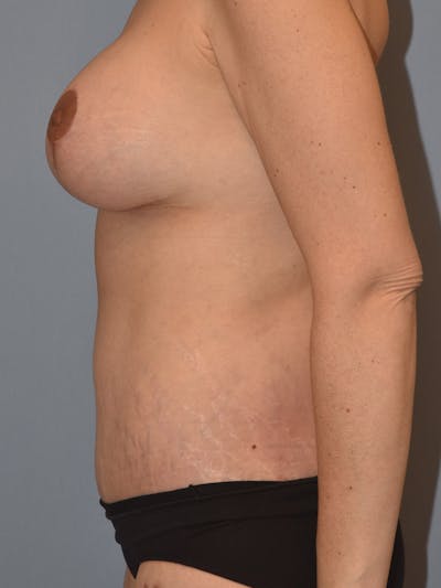 After Weight Loss Surgery Before & After Gallery - Patient 169243 - Image 10