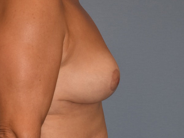 Breast Reduction Before & After Gallery - Patient 125850 - Image 6