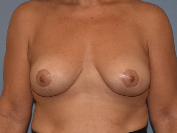 Breast Reduction Before & After Gallery - Patient 125850 - Image 2