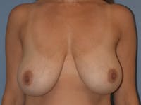 Breast Reduction Before & After Gallery - Patient 669789 - Image 1