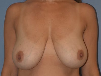 Breast Reduction Before & After Gallery - Patient 669789 - Image 1