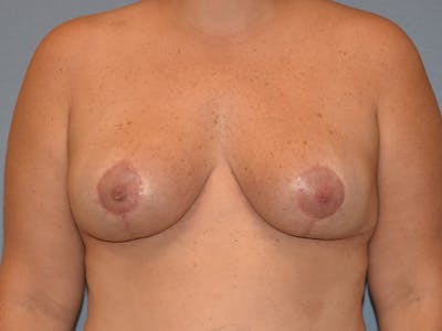 Breast Reduction Before & After Gallery - Patient 173095 - Image 2