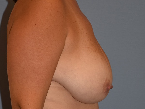 Breast Reduction Before & After Gallery - Patient 173095 - Image 5