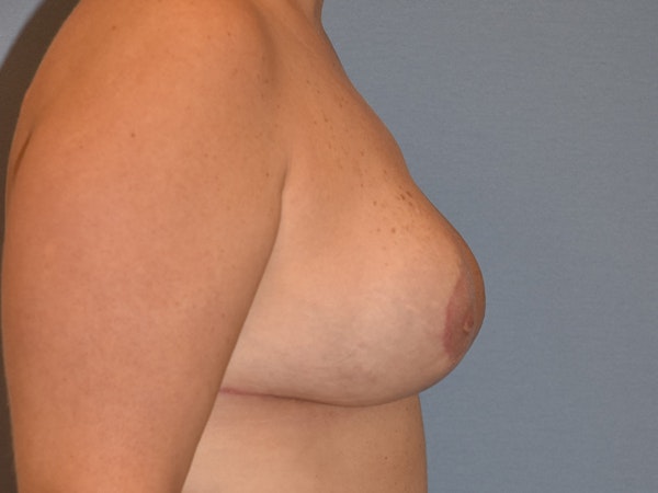 Breast Reduction Before & After Gallery - Patient 173095 - Image 6