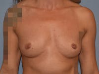 Breast Augmentation Before & After Gallery - Patient 226630 - Image 1