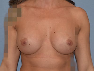 Breast Augmentation Before & After Gallery - Patient 226630 - Image 2